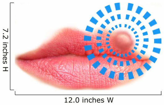 Close up of lips affected by herpes (cold sore) Wall Decal