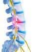 3d Rendered Illustration - Herniated Disk Wall Decal