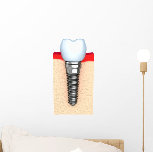 Dental implant in jaw bone Wall Decal