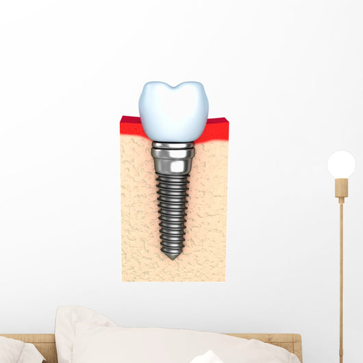 Dental implant in jaw bone Wall Decal