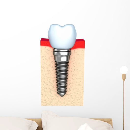 Dental implant in jaw bone Wall Decal