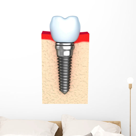 Dental implant in jaw bone Wall Decal