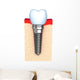 Dental implant in jaw bone Wall Decal
