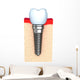 Dental implant in jaw bone Wall Decal