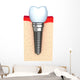 Dental implant in jaw bone Wall Decal