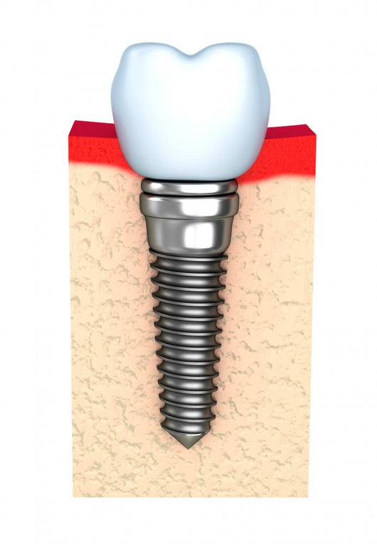 Dental implant in jaw bone Wall Decal