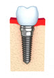Dental implant in jaw bone Wall Decal