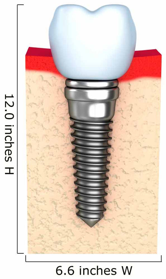 Dental implant in jaw bone Wall Decal