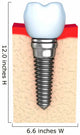 Dental implant in jaw bone Wall Decal