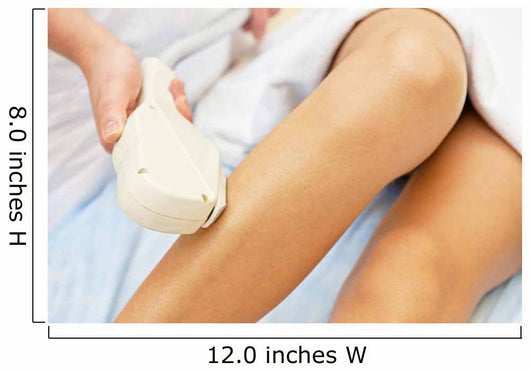 Laser Epilation