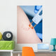 Varicose Veins Laser Cosmetics