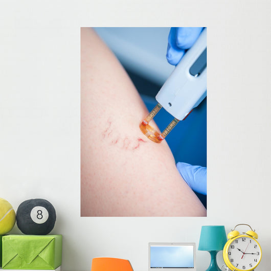 Varicose Veins Laser Cosmetics