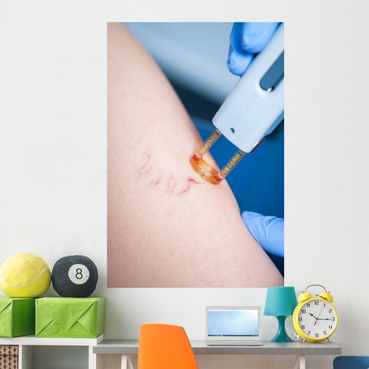 Varicose Veins Laser Cosmetics