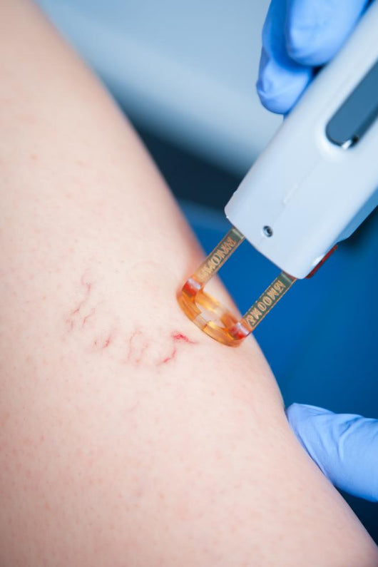 Varicose Veins Laser Cosmetics