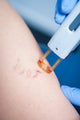 Varicose Veins Laser Cosmetics