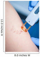 Varicose Veins Laser Cosmetics