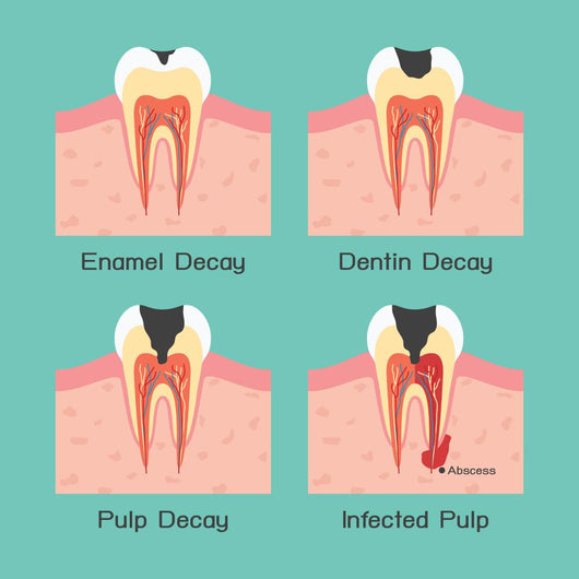 Tooth Decay Wall Mural