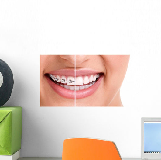 Healthy Smile with Braces Wall Decal