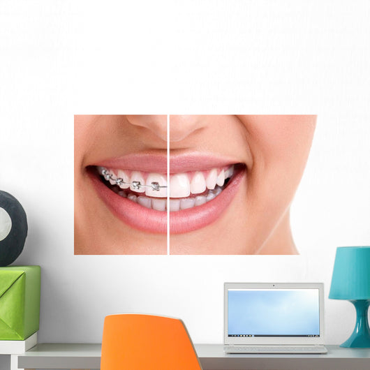 Healthy Smile with Braces Wall Decal