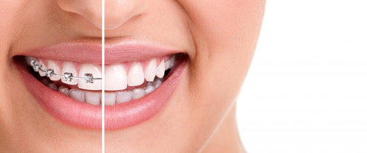 Healthy Smile with Braces Wall Decal