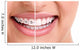 Healthy Smile with Braces Wall Decal