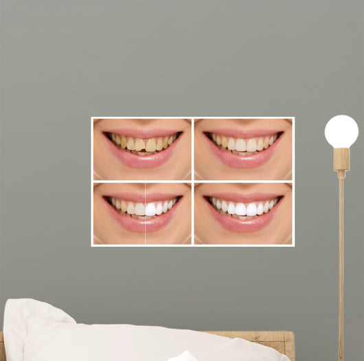 Teeth decay cure. Tooth whitening. Before and after. 