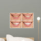 Teeth decay cure. Tooth whitening. Before and after. 