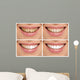Teeth decay cure. Tooth whitening. Before and after. 