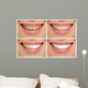 Teeth decay cure. Tooth whitening. Before and after. 