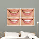 Teeth decay cure. Tooth whitening. Before and after. 