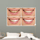 Teeth decay cure. Tooth whitening. Before and after. 