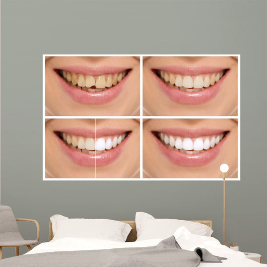 Teeth decay cure. Tooth whitening. Before and after. 