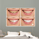 Teeth decay cure. Tooth whitening. Before and after. 