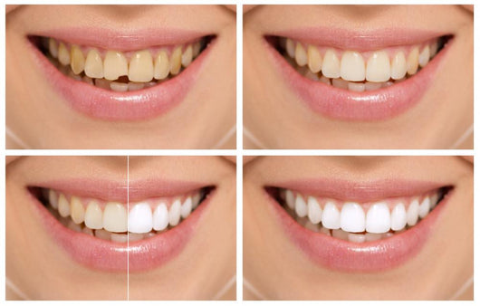 Teeth decay cure. Tooth whitening. Before and after. 