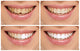 Teeth decay cure. Tooth whitening. Before and after. 