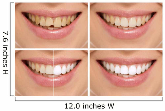 Teeth decay cure. Tooth whitening. Before and after. 
