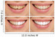 Teeth decay cure. Tooth whitening. Before and after. 