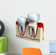 Dental crown installation process, isolated on white Wall Decal