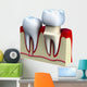 Dental crown installation process, isolated on white Wall Decal