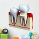 Dental crown installation process, isolated on white Wall Decal