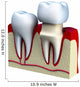Dental crown installation process, isolated on white Wall Decal