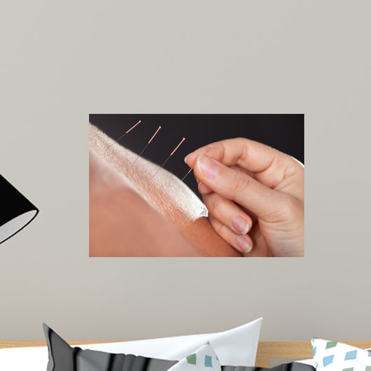 Man Getting Acupuncture Treatment 