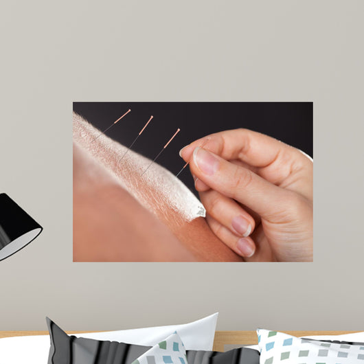 Man Getting Acupuncture Treatment 