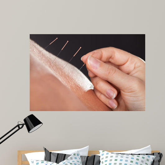 Man Getting Acupuncture Treatment 