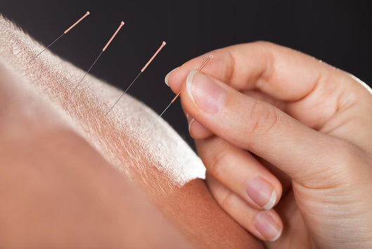 Man Getting Acupuncture Treatment 