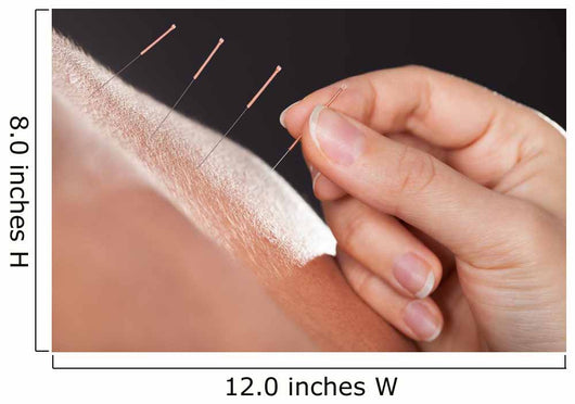 Man Getting Acupuncture Treatment 