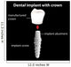 A Dental Implant With Crown 