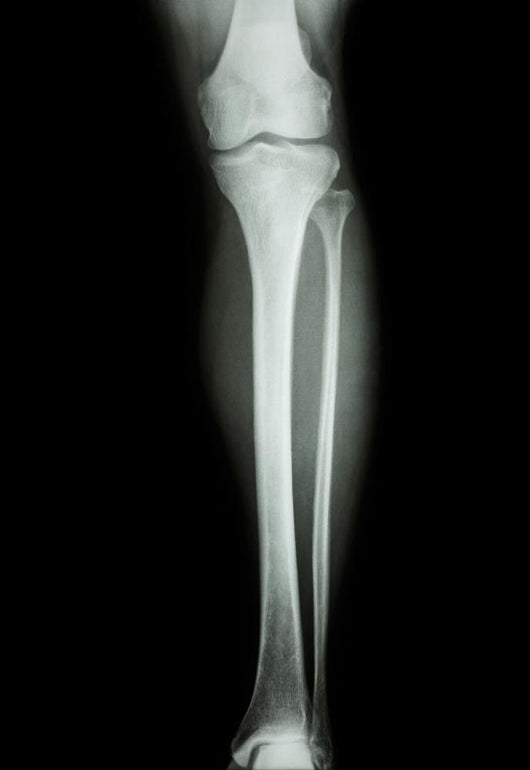 Film X-Ray Normal Humans Leg 