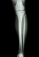 Film X-Ray Normal Humans Leg 