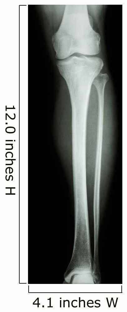 Film X-Ray Normal Humans Leg 